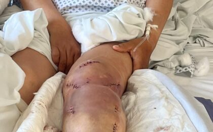 Una mujer sufre heridas graves tras caer en un bache en Mixquiahuala