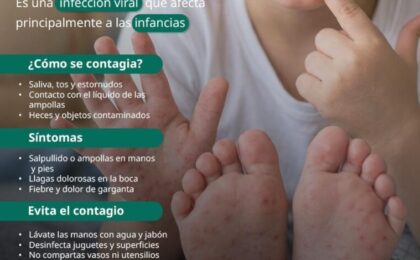 El IMSS en Hidalgo ofrece recomendaciones para prevenir enfermedades por el virus Coxsackie